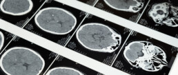 brain scans